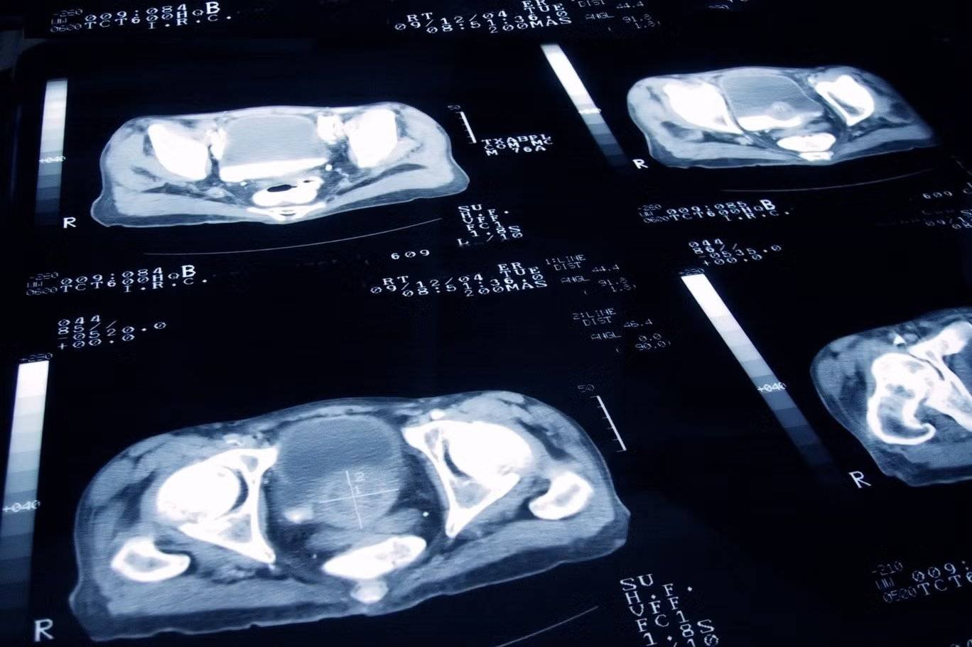 أشعة سرطان البروستاتا 