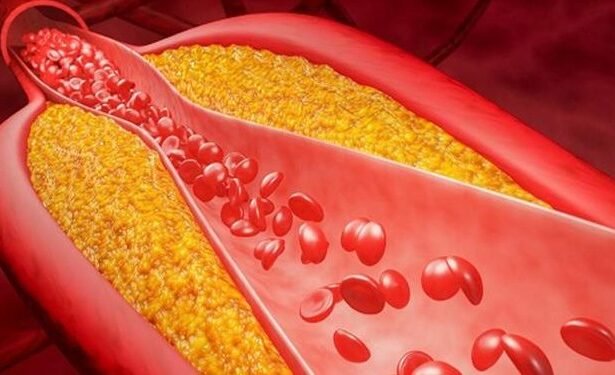 علاج جيني للكوليسترول