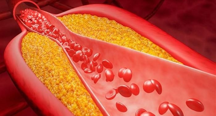 علاج جيني للكوليسترول