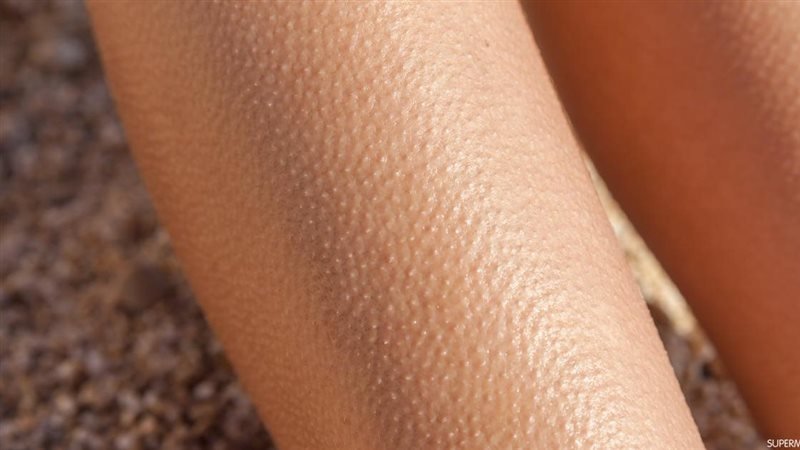 علاج جلد الوزة طبيعيًا