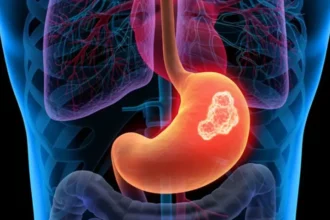 سرطان المعدة