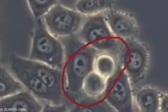 سرطان البنكرياس