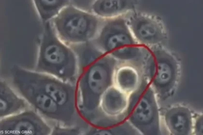 سرطان البنكرياس