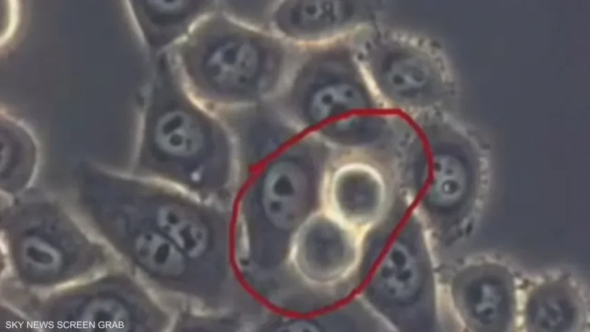 سرطان البنكرياس