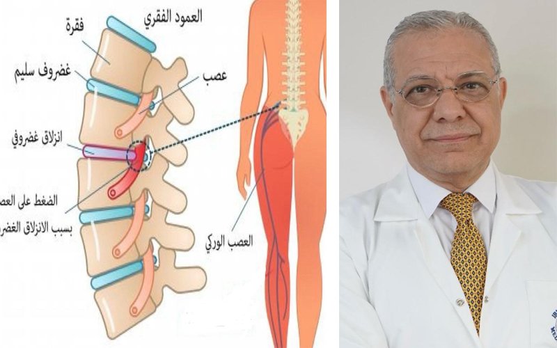 الانزلاق الغضروفي
